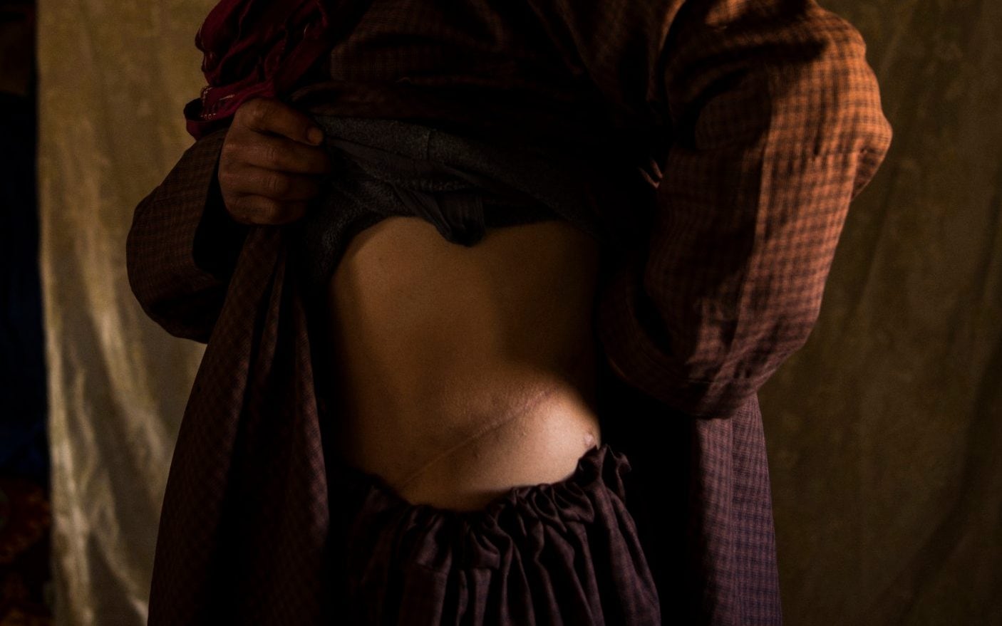 Scars Emenated From Organ Harvesting Surgery On A Donor